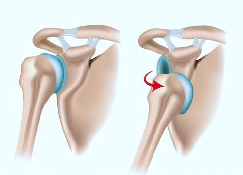 Jorge-Camacho-inestabilidad-hombro