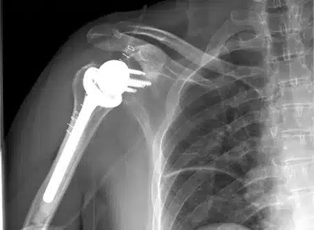 Jorge-Camacho-protesis-hombro